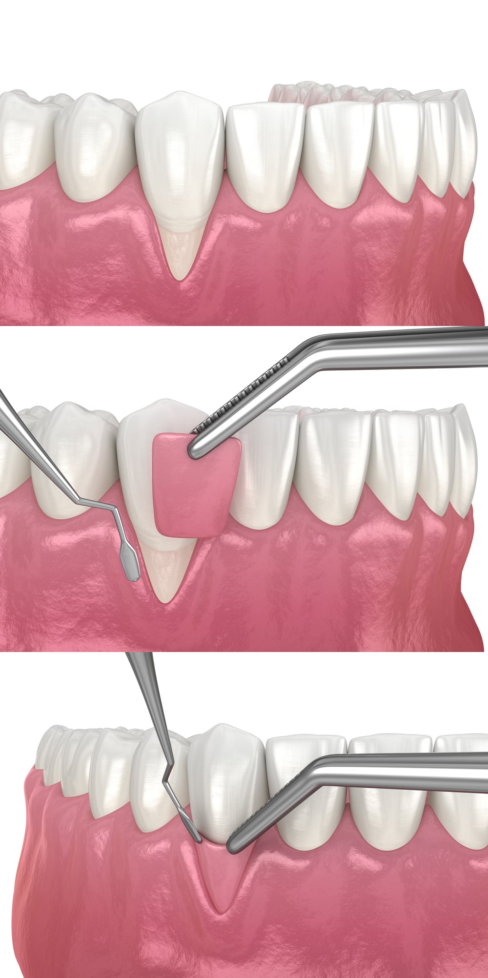 LANAP laser gum therapy in a modern periodontal practice