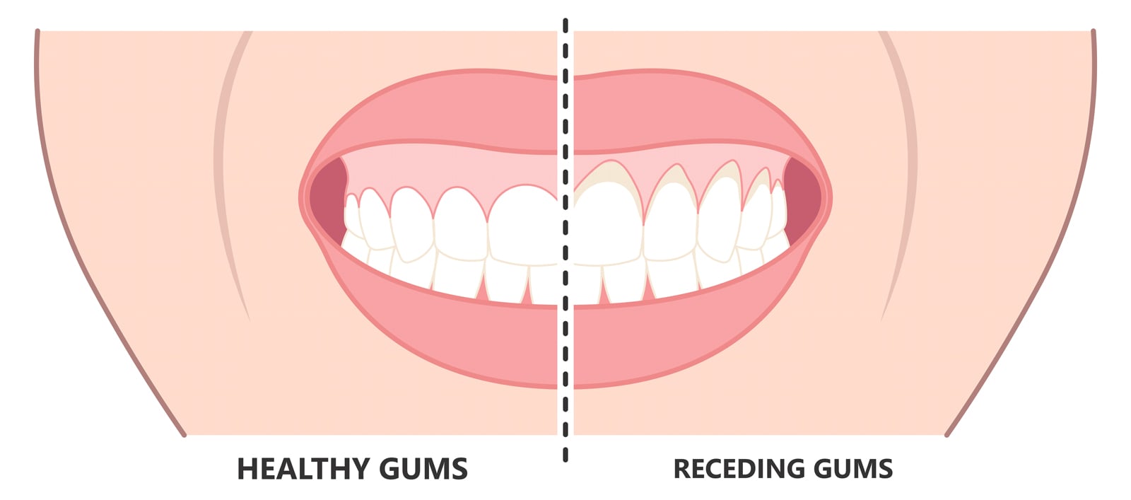 Gum Disease Treatment procedure illustration