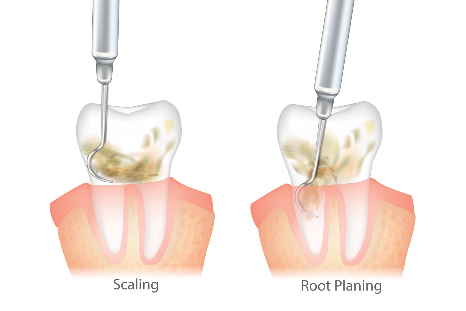 Gum Disease Treatment - visual example