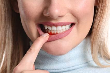 Gingivectomy / Gingivoplasty (Cosmetic Gum Contouring)
