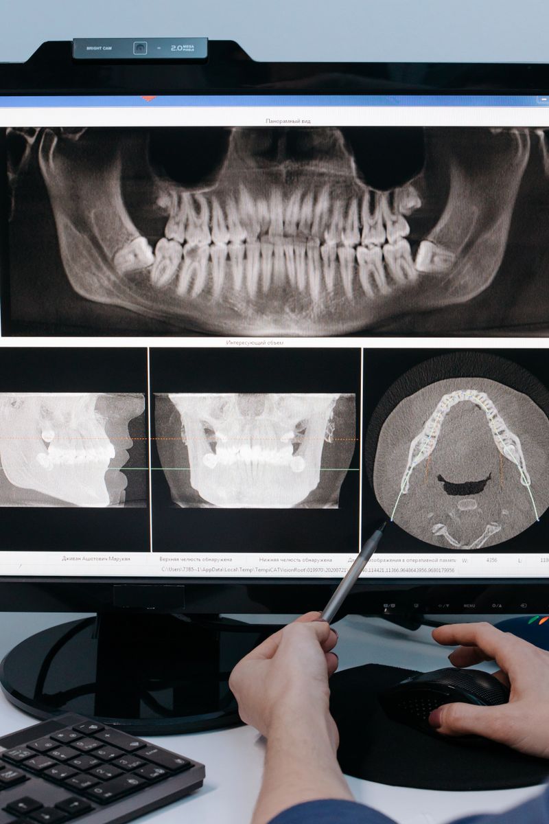 Sinus Augmentation (Sinus Lift)