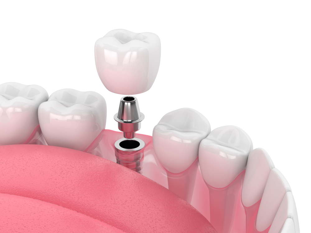 Reasons for dental implants List