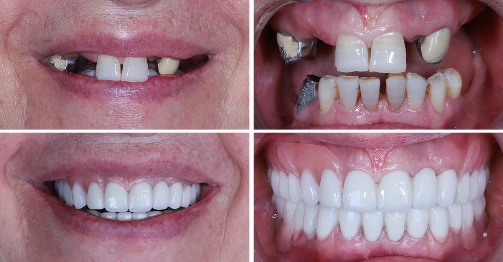 Dental Implants Before and After